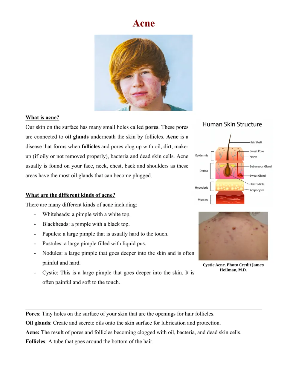 What is acne: students read how clogged pores form pimples, six acne types and a labeled human skin structure diagram