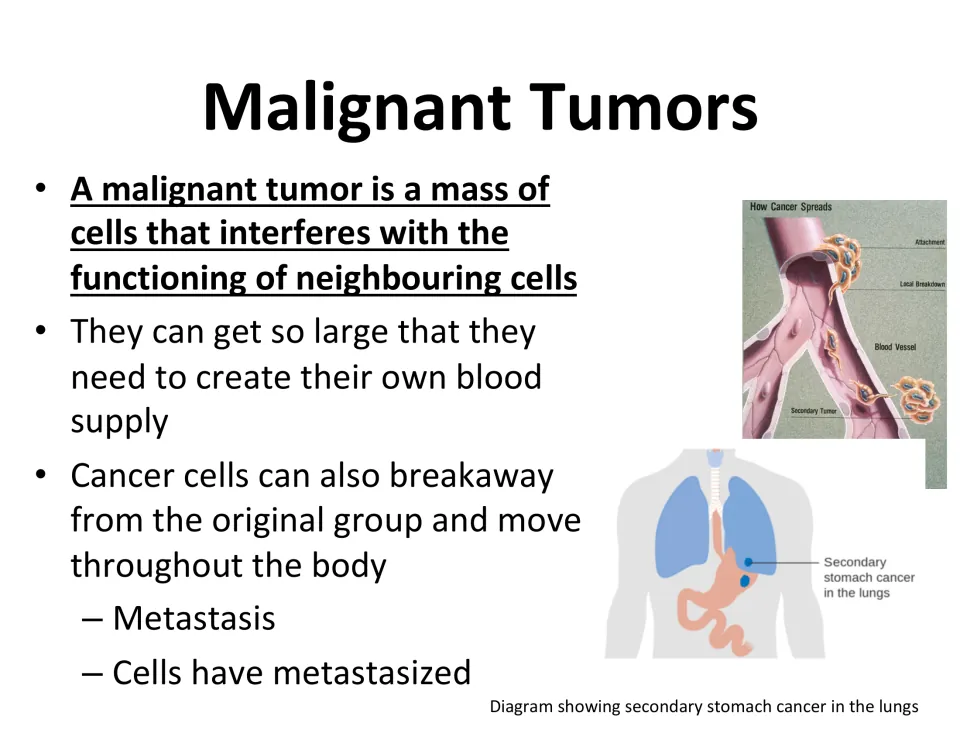 Malignant tumor lesson slide explains effects on neighboring cells, blood supply, and metastasis to lungs