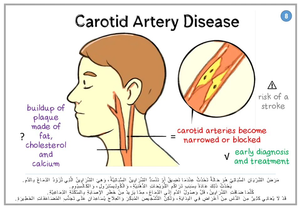 Carotid artery disease poster 8: plaque buildup, narrowed arteries and stroke risk, with Arabic text