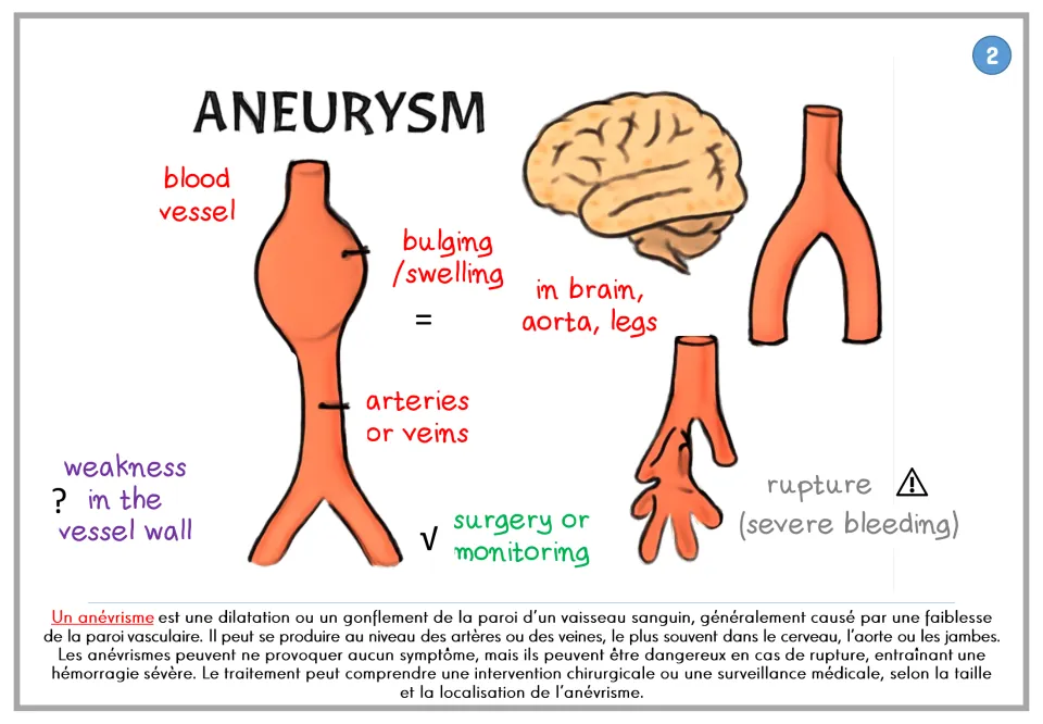 Aneurysm poster showing a bulging blood vessel, rupture risk, and surgery or monitoring, with French text