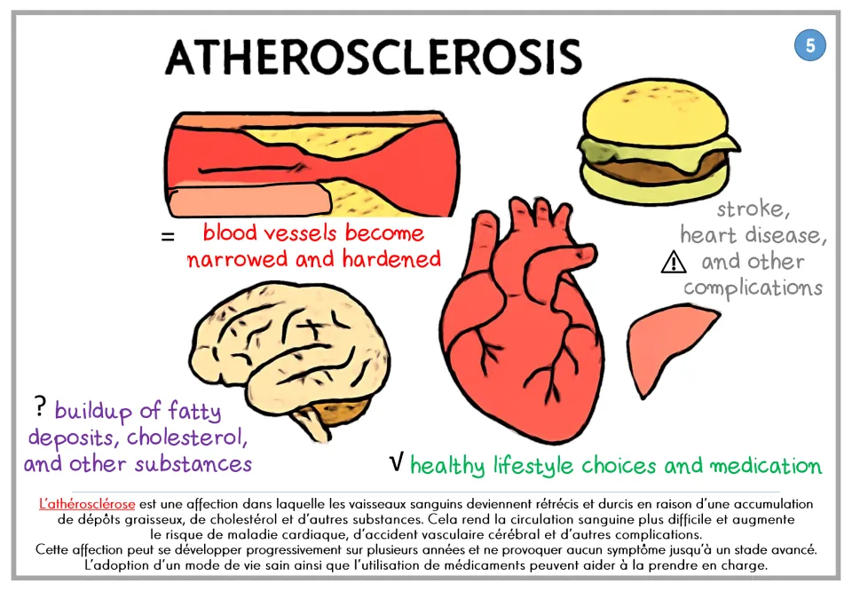 Atherosclerosis poster showing fatty deposits narrowing blood vessels and related risks, with French text