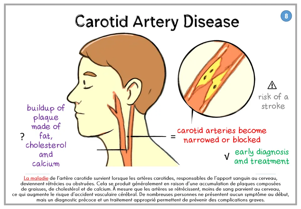 Carotid artery disease poster showing plaque buildup, narrowed arteries, and stroke risk, with French text
