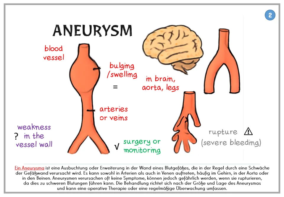 Aneurysm poster 2: blood vessel bulging, weak vessel walls, rupture risk, and treatment, plus German text