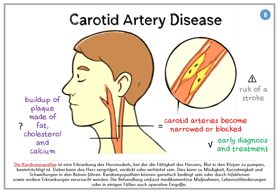Carotid artery disease poster 8: plaque buildup, narrowed carotid arteries, stroke risk, and treatment notes