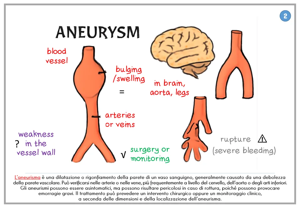 Aneurysm poster showing blood vessel swelling, rupture risk, and treatment, with Italian explanatory text