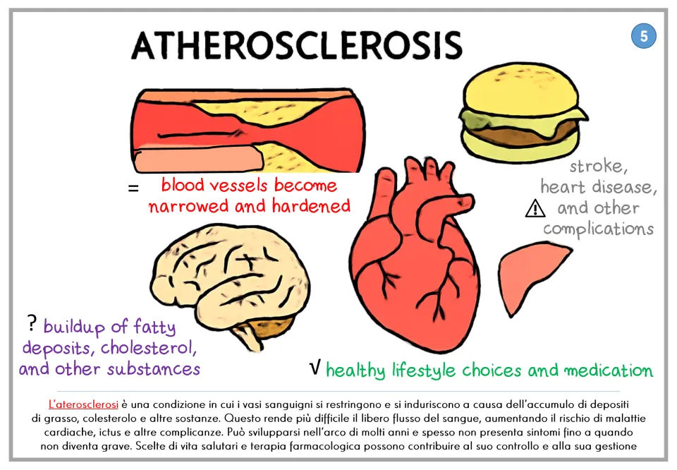 Atherosclerosis poster showing narrowed blood vessels and fatty deposits, with an Italian explanation
