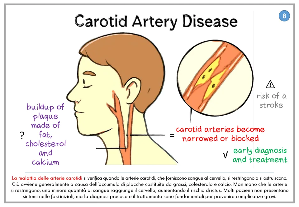 Carotid artery disease poster showing plaque buildup and narrowed neck arteries, with Italian explanatory text