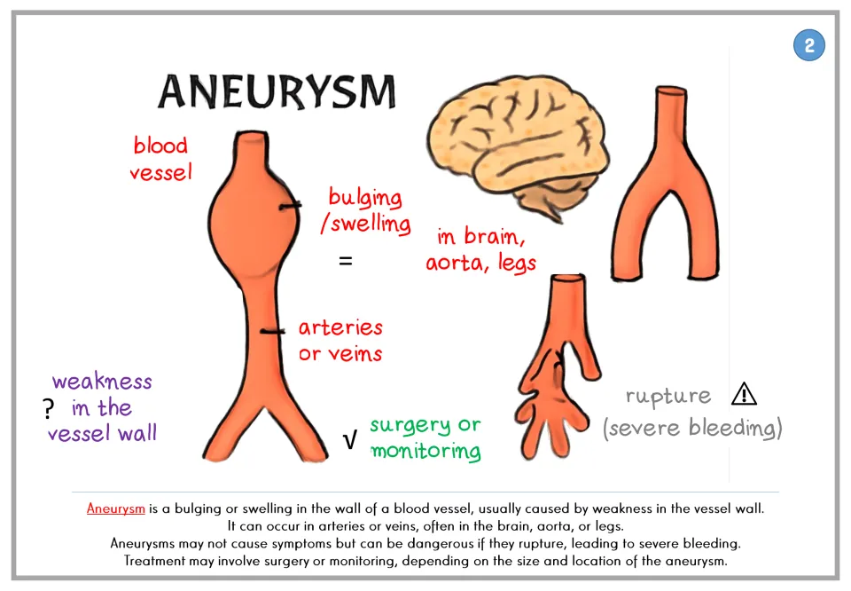 Aneurysm poster: a weak, bulging blood vessel wall in the brain, aorta or legs that can rupture; surgery or monitoring