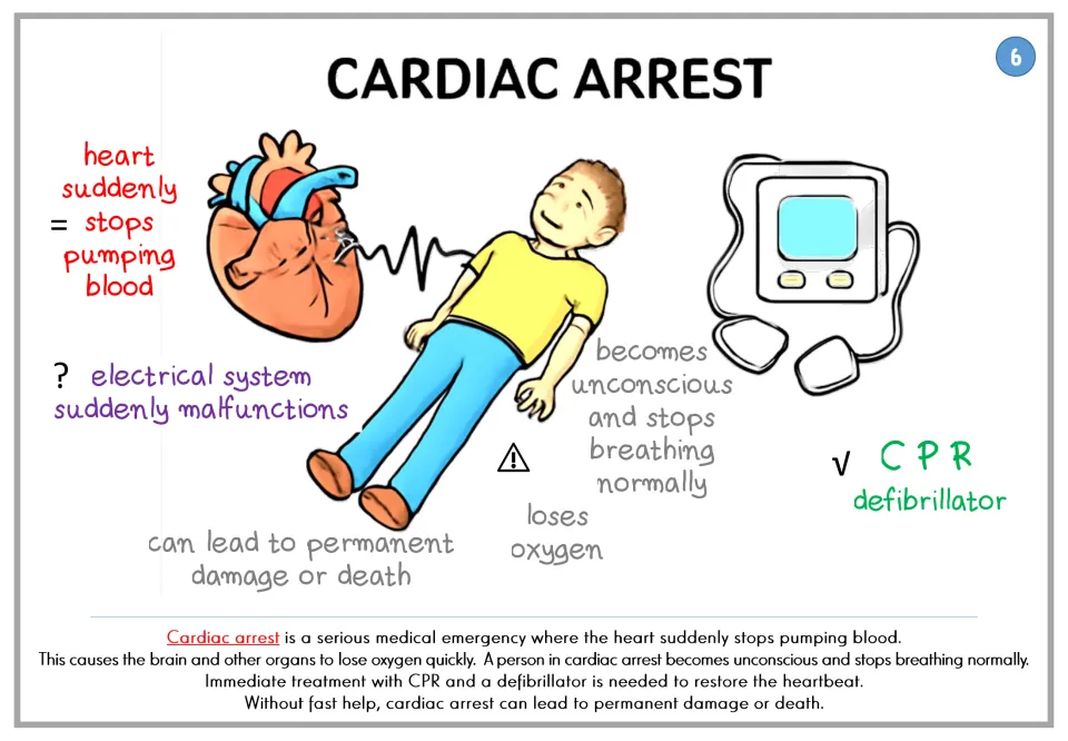 Cardiac arrest poster: the heart suddenly stops pumping and the person becomes unconscious; CPR and a defibrillator