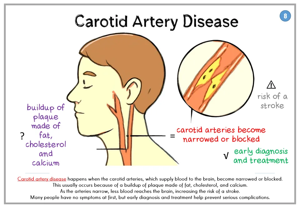 Carotid Artery Disease poster: plaque of fat, cholesterol and calcium narrows the neck arteries, raising stroke risk