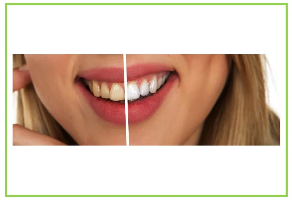 Dentist-themed writing and discussion card 6: a smiling mouth showing yellowish teeth beside whiter teeth