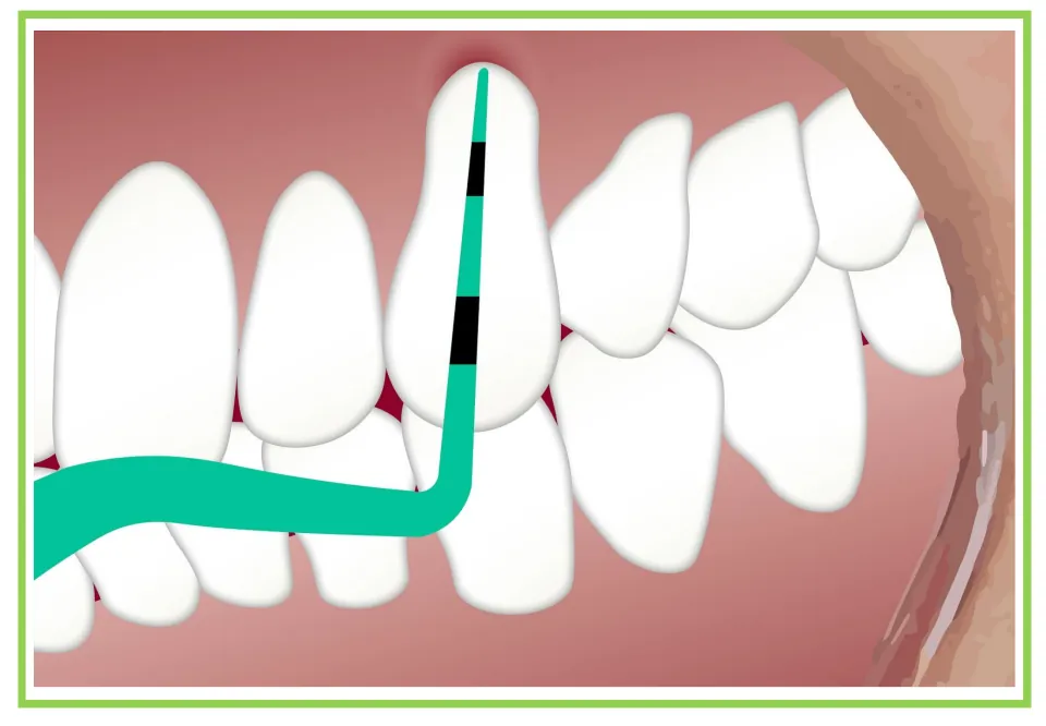 Dentist-themed writing and discussion card 7: a green dental probe with black markings beside a tooth