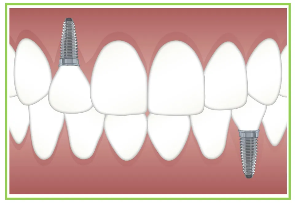Dentist-themed writing and discussion card 10: teeth and gums illustrated with two screw-shaped implants