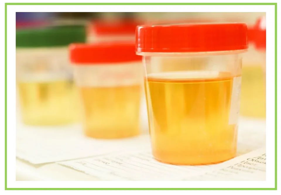 Medical center writing and discussion flashcard 2 shows urine specimen containers with colored lids.