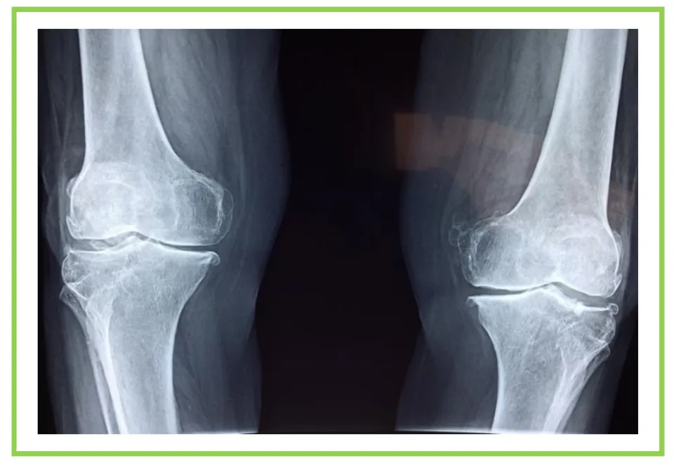 Medical center writing and discussion flashcard 4 shows an X-ray of both knees and surrounding bones.